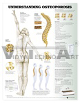 Understanding Osteoporosis Anatomical Chart